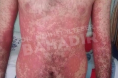 Before treatment