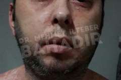 Before treatment