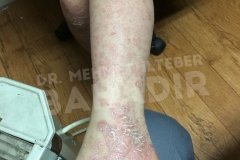 Before treatment