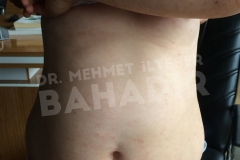 After treatment