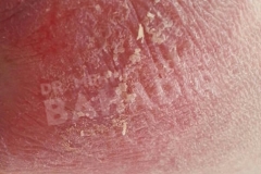 Before treatment