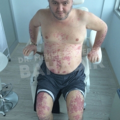 Patient Yakup Genc