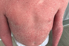 Before treatment
